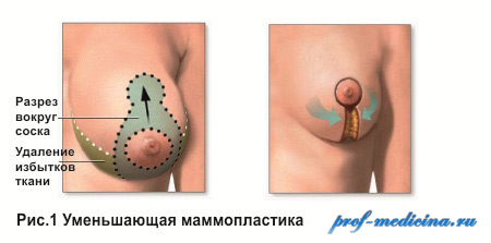 Вкладыши увеличения груди купить