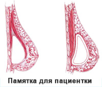 Увеличение груди. Памятка пациентке