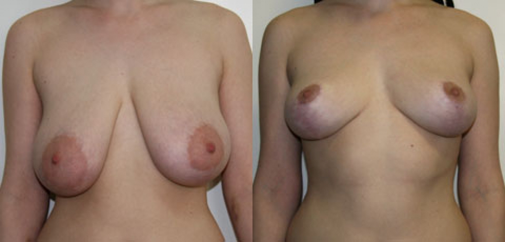 Уменьшение груди (молочных желёз) или редукционная маммопластика - хирургич
