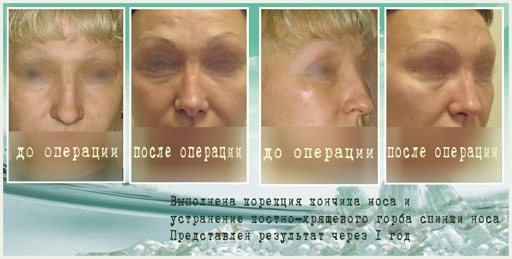 операция на груди подтяжка с липосакцией операция на груди подтяжка с липосакцией