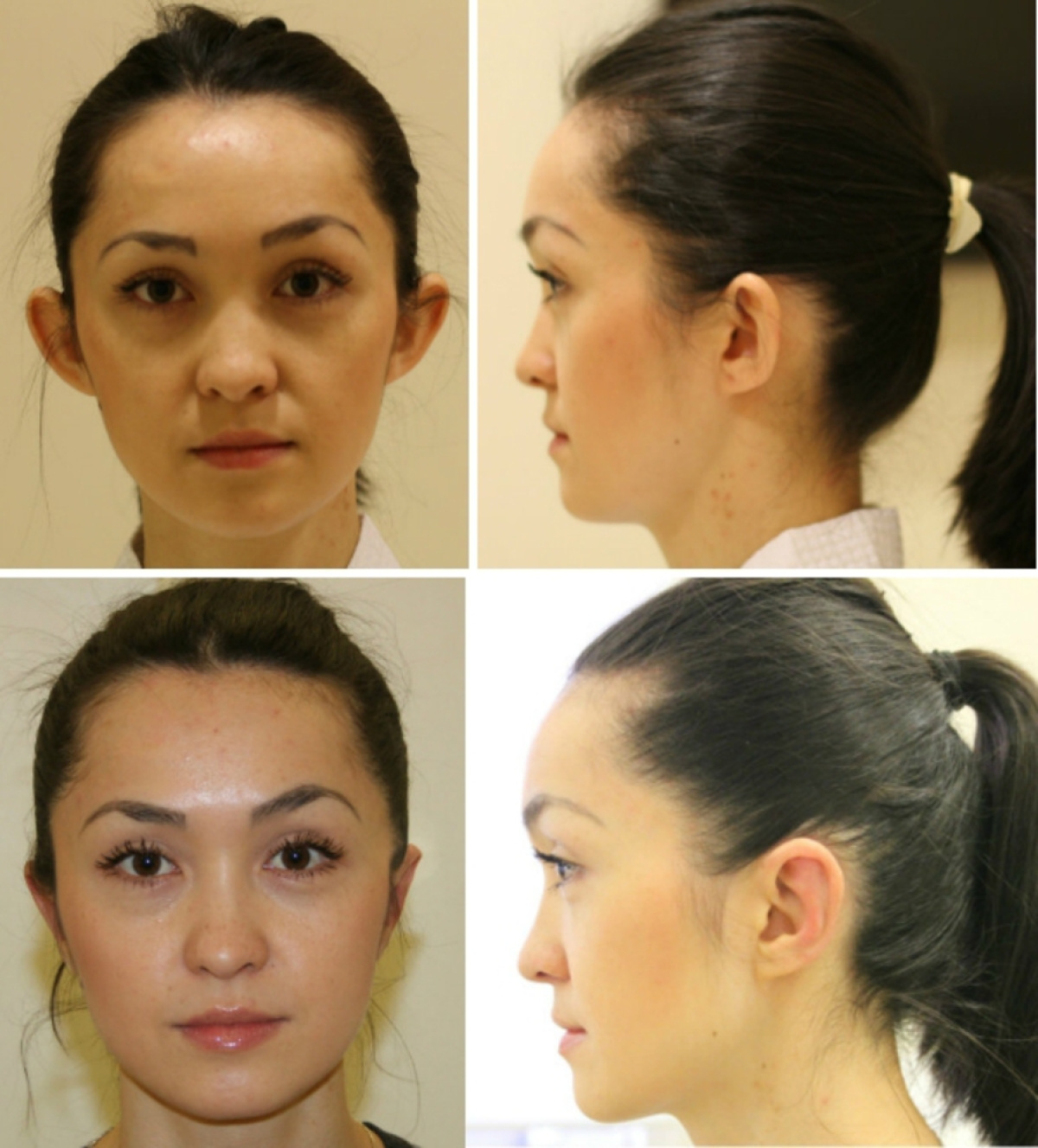 Курение после отопластики Курение после отопластики