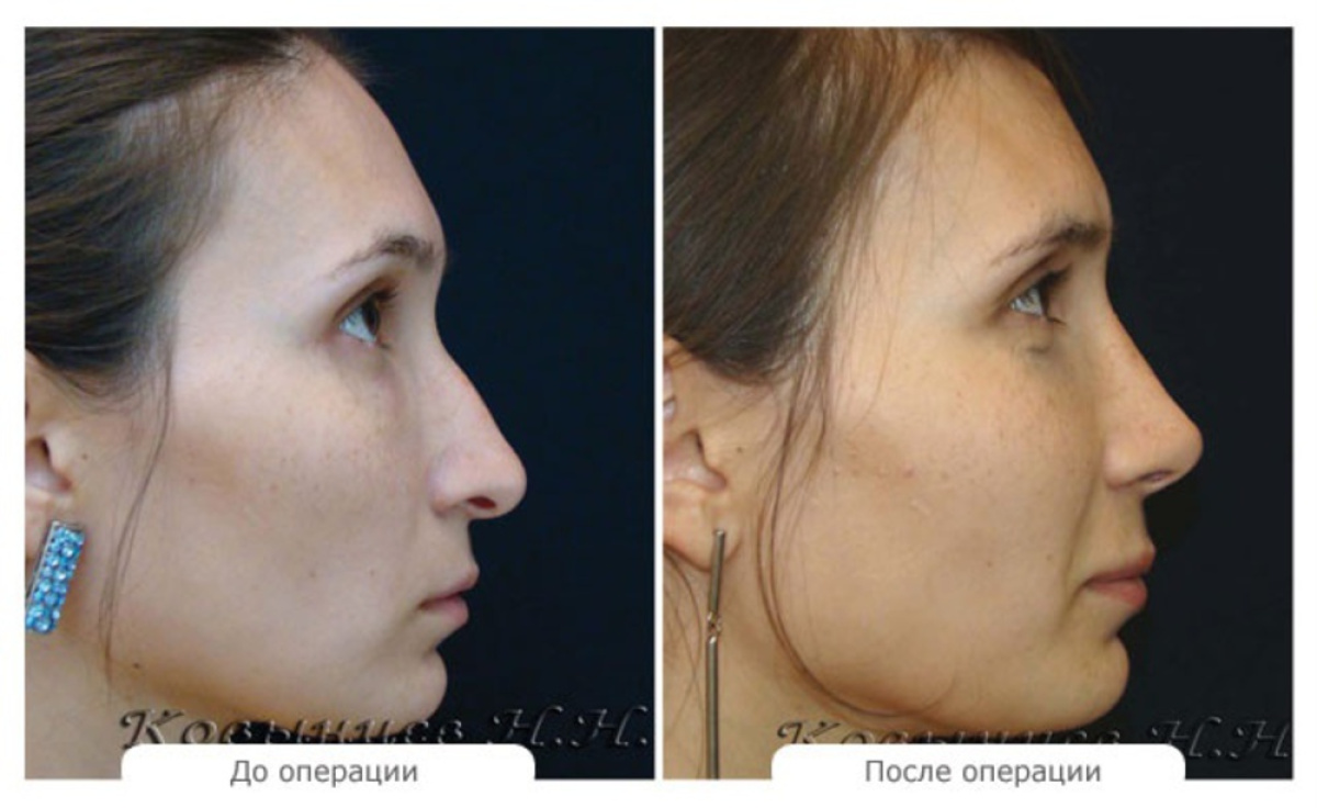 Ринопластика николаев отзывы Ринопластика николаев отзывы