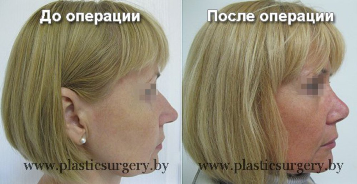 Ринопластика у куриловича Ринопластика у куриловича