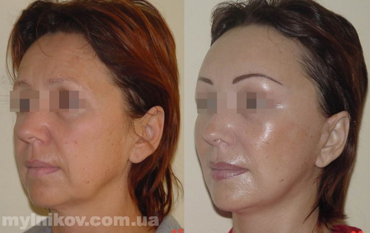 Модные женские стрижки 2018: лучшие идеи, фото новинки, на короткие Металлические коронки на зубы - цены, фото, отзывы