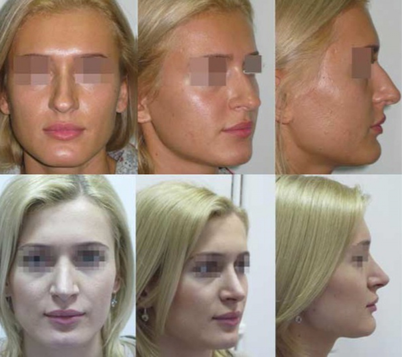 Сода от целлюлита отзывы