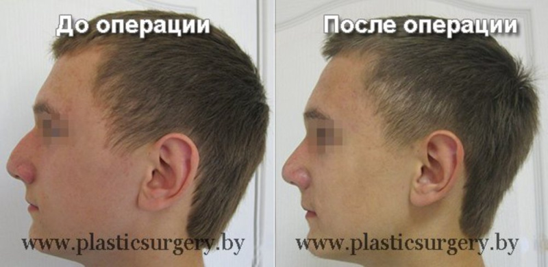 Ринопластика у куриловича Ринопластика у куриловича