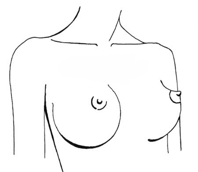 Формы женской груди.