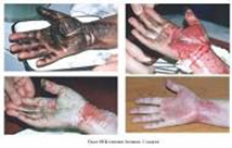 Искусственная кожа «Стратаграфт»: лечение тяжелых термических ожогов thumbnail