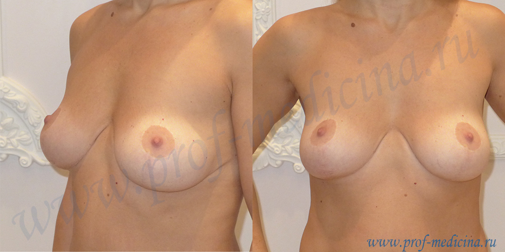 Вторичное опущение груди после мастопексии