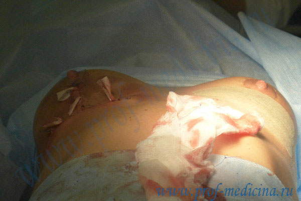 Операция по удалению гематомы груди