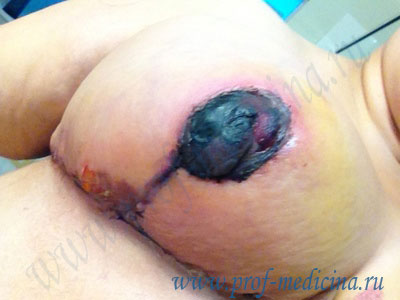 Некроз ареолы после мастопексии