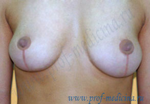 Асимметрия груди после мастопексии