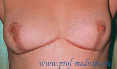 Грубые рубцы после мастопексии
