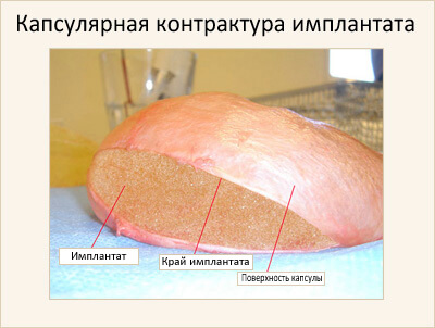 Увеличение грудных желез побочное действие