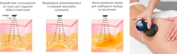 Методика удаления жира ультразвуком