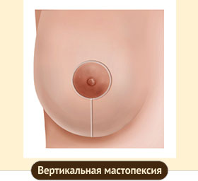 Вертикальный разрез при мастопексии 