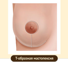 Якорный разрез при мастопексии
