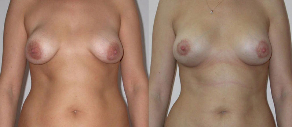 Фото до и после циркулярной подтяжки груди