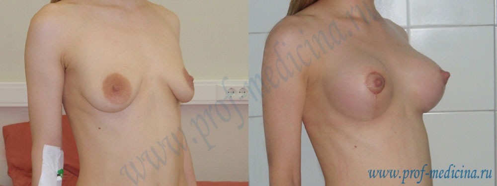 Фото до и после вертикальной мастопексии