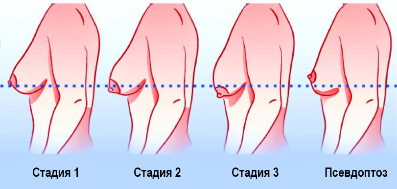 Стадии птоза молочной железы