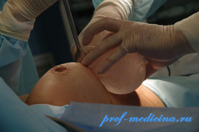 установка имплантата груди