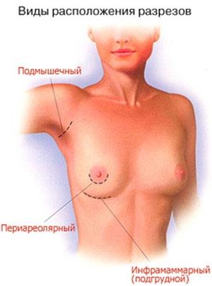 Клиники В Екaтеринбурге По Увеличение Груди