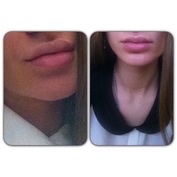 Губы 2 мл до и после фото. Накаченные губы 2 мл до и после. Накаченные губы до и после 1. Полные девушки с увеличенными губами