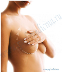 Показания к операции по подтяжке груди