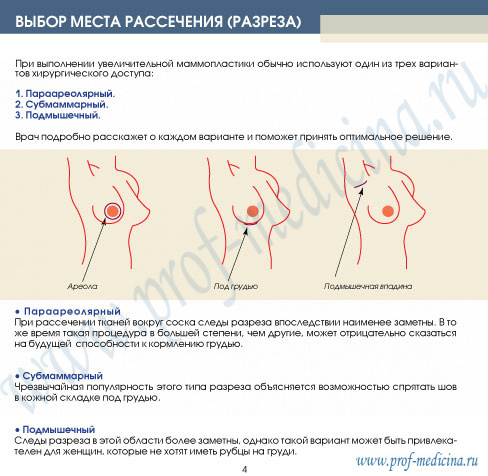 выбор доступа при маммопластике