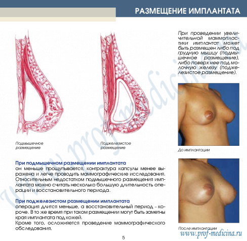 размещение имплантата при увеличении груди