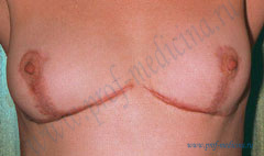 Келоидные рубцы после подтяжки груди