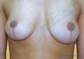 Асимметрия после подтяжки груди 