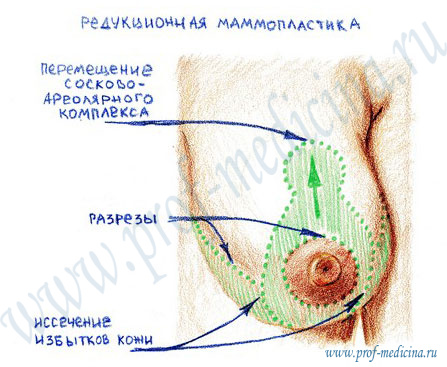 Что нужно знать о редукции груди