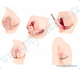 Уменьшение груди якорным способом