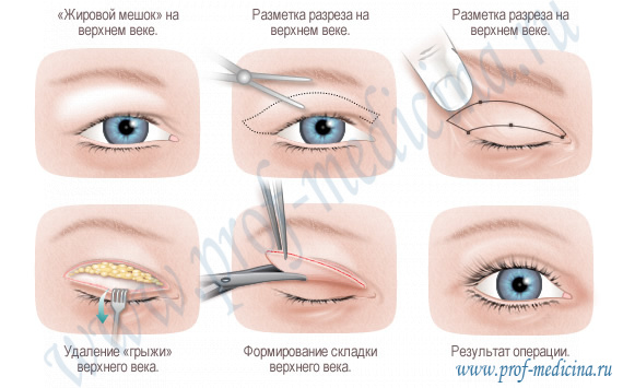 Верхняя блефаропластика