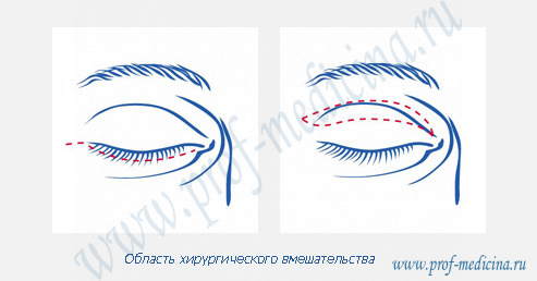 Операция по блефаропластике