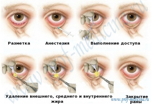 Трансконьюнктивальная блефаропластика