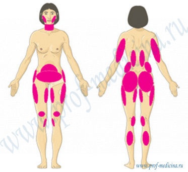 Локализация жировых отложений