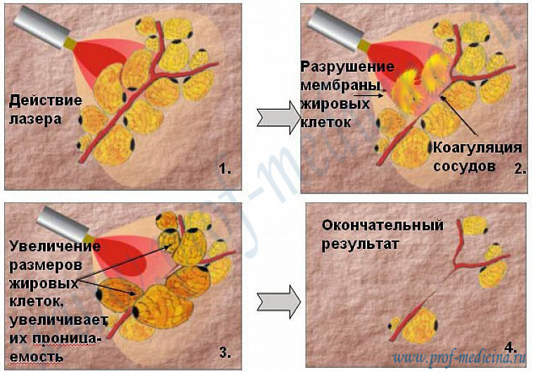 Липосакция лазером