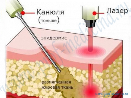 Липосакция с помощью лазера