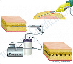 Липосакция вакуумом