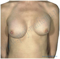 Фиброзная капсулярная контрактура груди