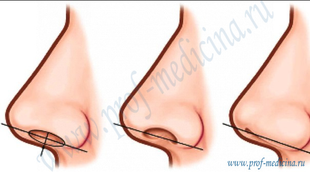 Уменьшение носа