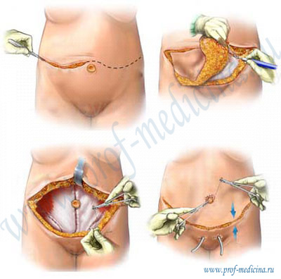 Ход операции по пластике живота