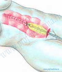 Эндоскопическая абдоминопластика