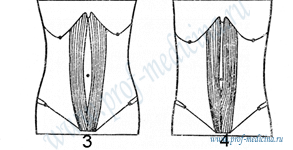 Виды прямых мышц живота