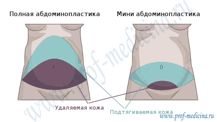 Отличие миниабдоминопластики от классической пластики живота