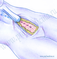 Ход операции миниабдоминопластики