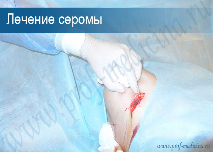 Удаления серомы груди