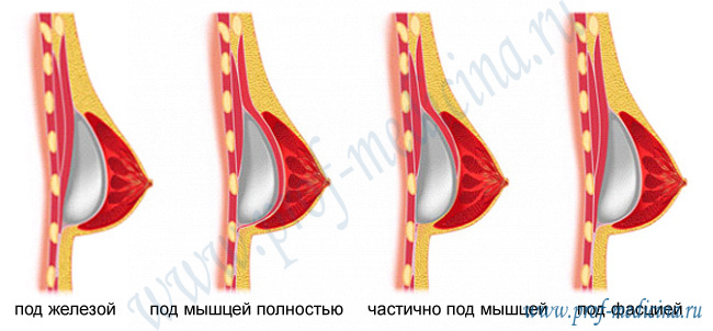 Имплант под мышцу сколько болит